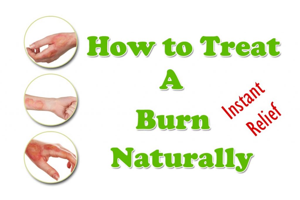 Burn Treatment How To Treat A Burn Naturally Best Home Remedies For